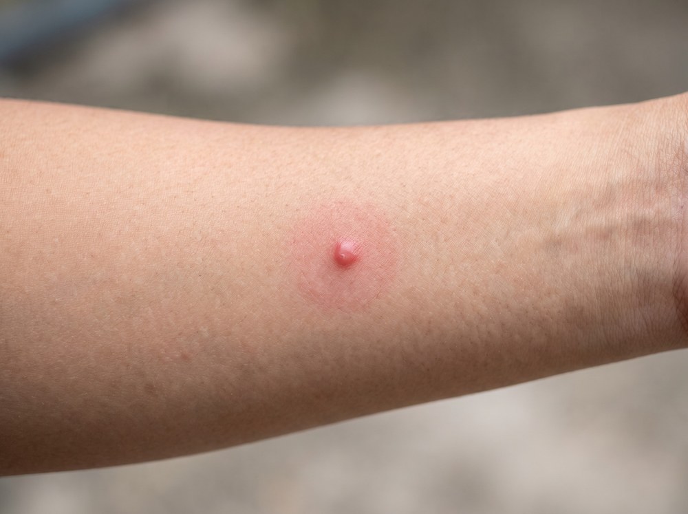 Close-up of scattered red itchy bumps on skin caused by carpet beetle larval hair contact rather than a true bite